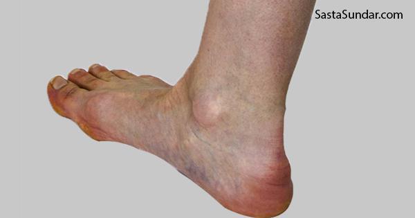 Natural Remedies For A Heel Spur